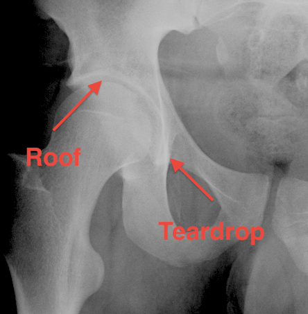 Acetabulum Roof and Teardrop